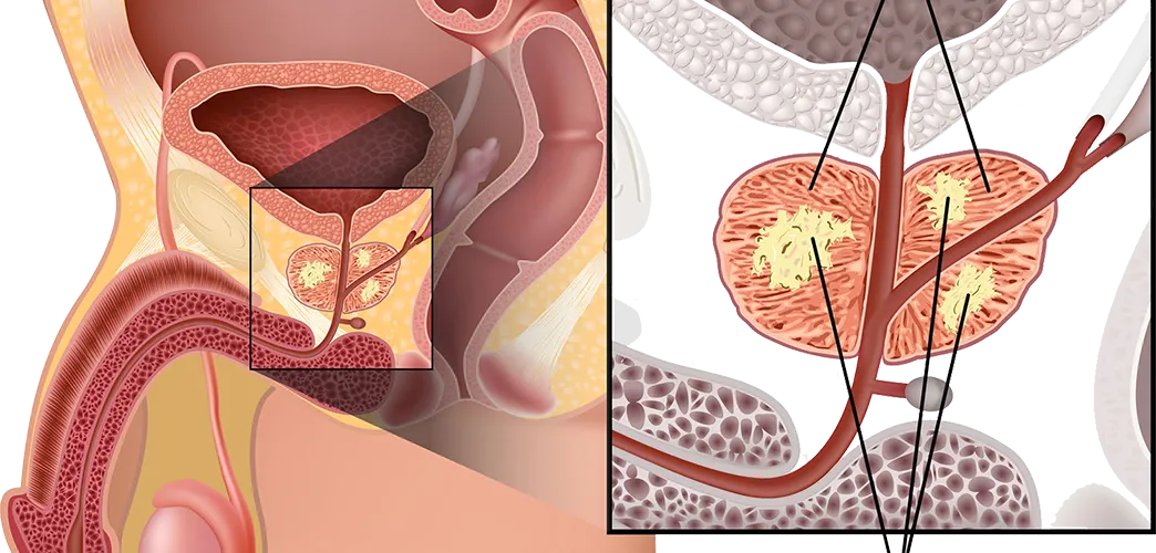 O que é o Câncer de Próstata