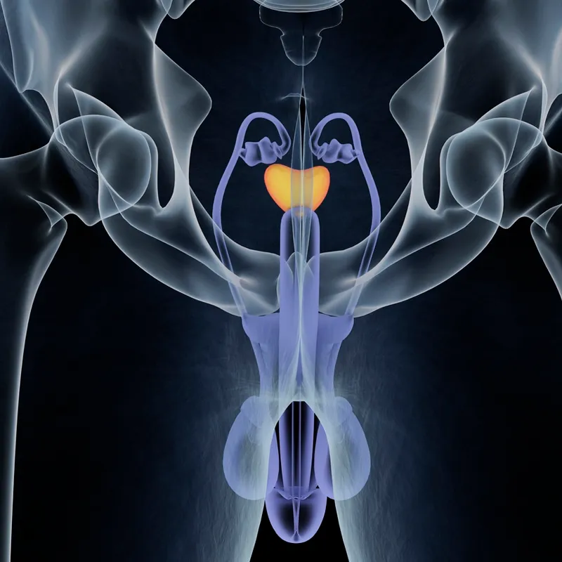 Testosterona e a Evolução do Câncer de Próstata