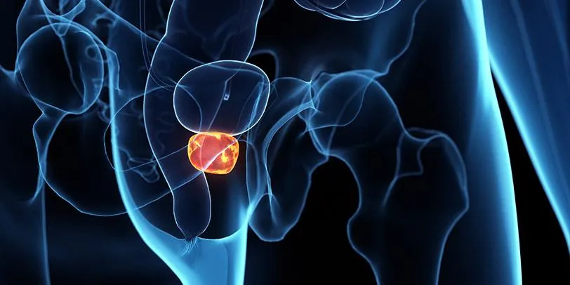 Prostatite: o que é, sintomas, causas e tratamento