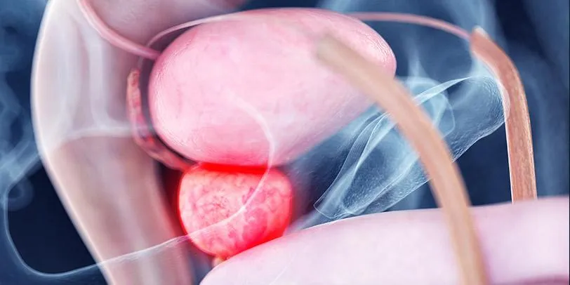 Hiperplasia prostática